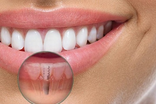 Implante Dentárioe